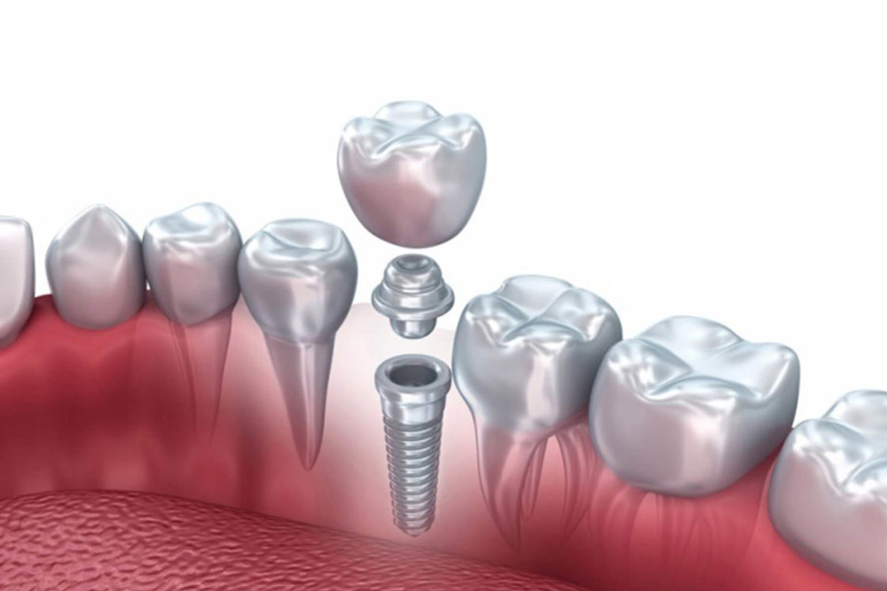 Dental Implant