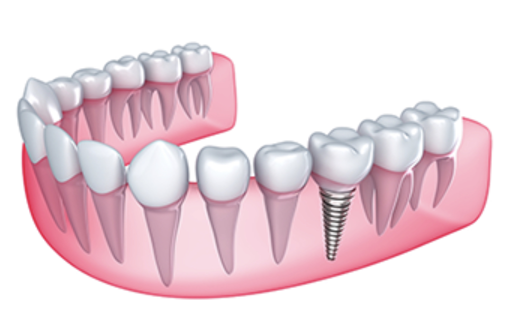 Dental Implant + Abutment + Crown