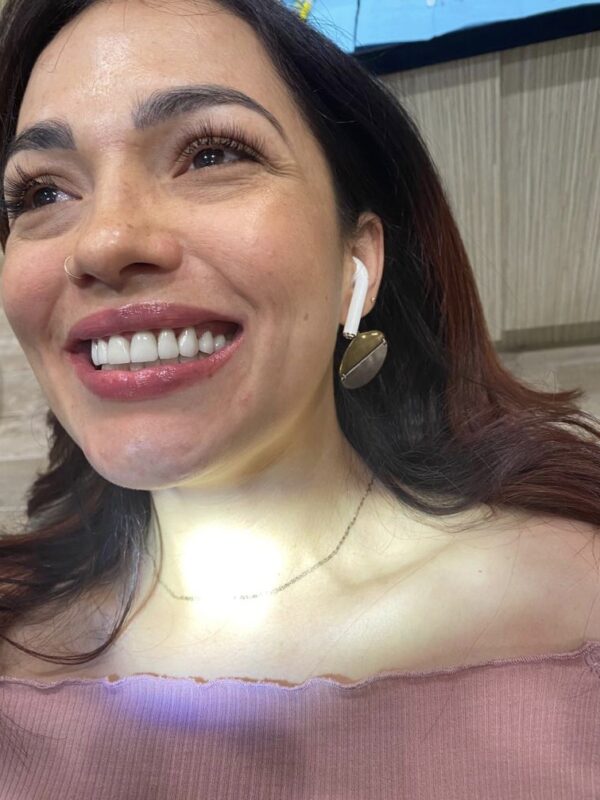 Smile Makeover with Four Veneers