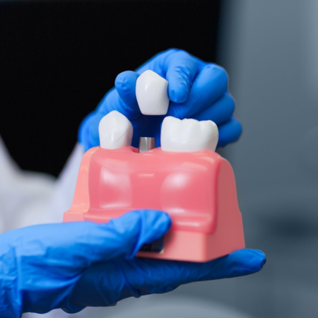 One Ceramic Crown + Exam, X-ray, Cleaning & Take- Home Whitening