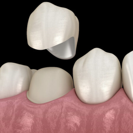 Ceramic Crown with Exam & X-ray