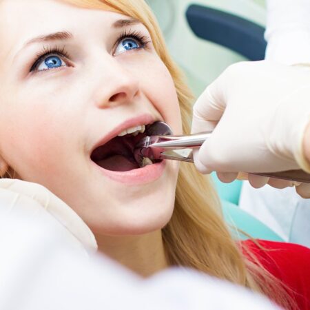Four Wisdom Teeth Extraction + X-ray + IV Anesthesia