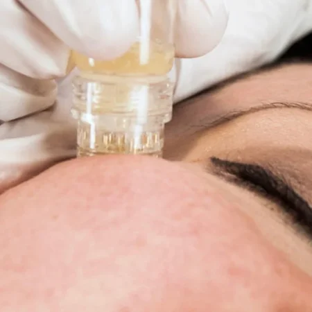 Microinfusion with Hydrofacial