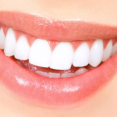Teeth Whitening