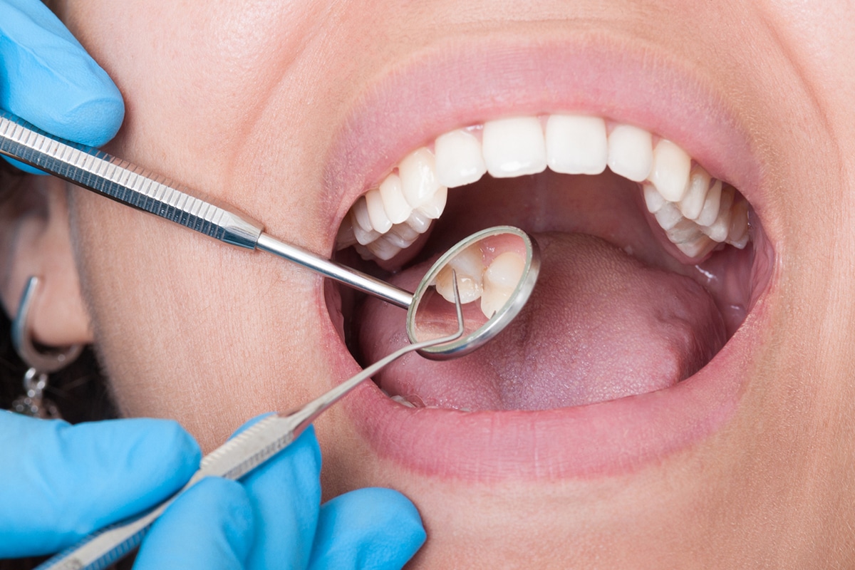 Dental Extraction