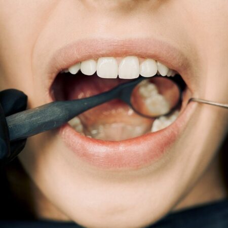 Dental Cleaning