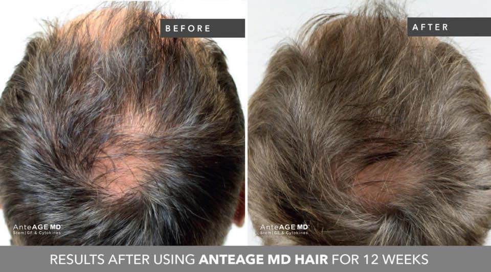 Medical Grade Hair Restoration Treatment