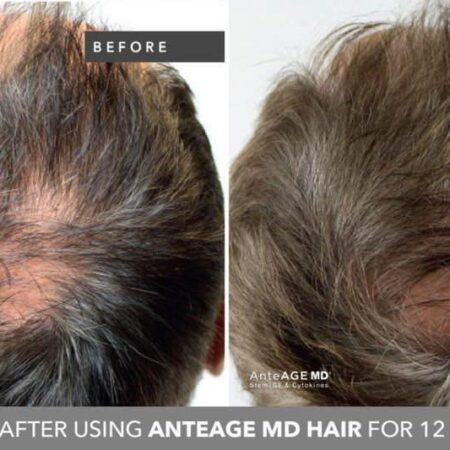 Medical Grade Hair Restoration Treatment